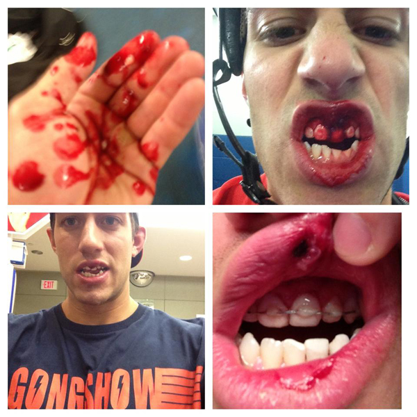 Hockey Teeth Knocked Out